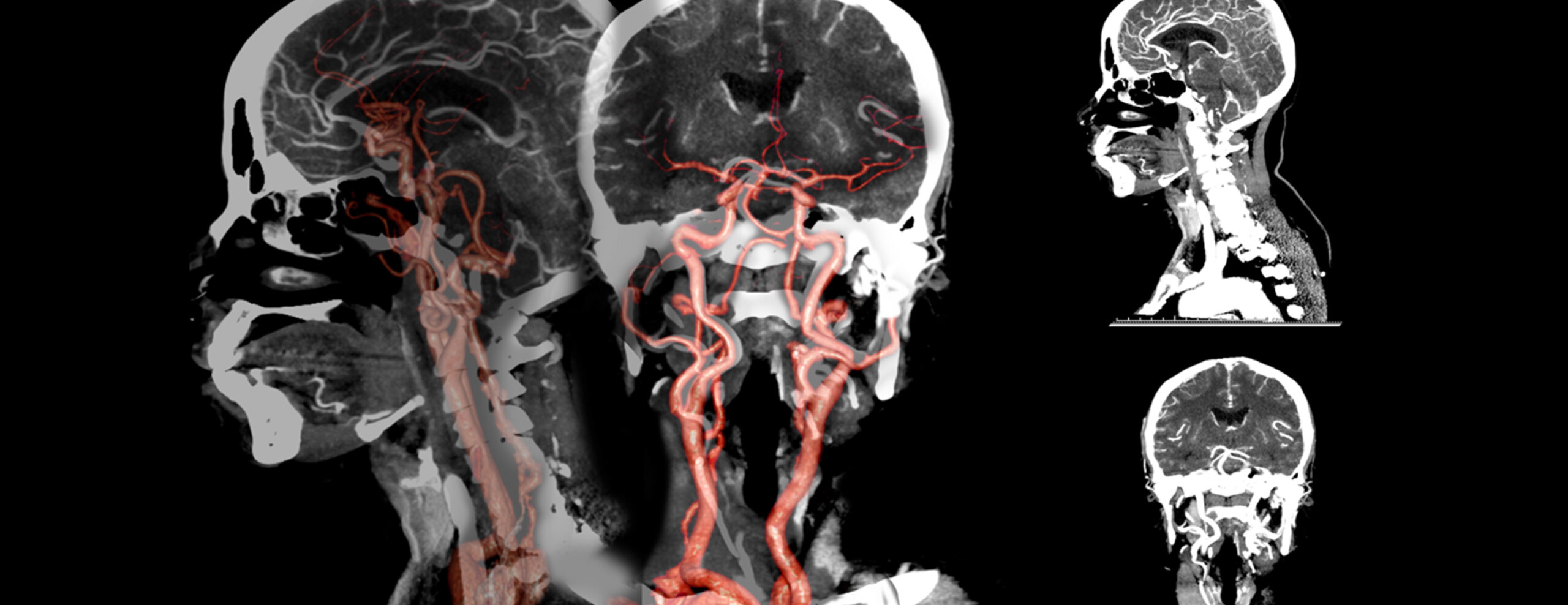 ct-angiography-head-and-neck